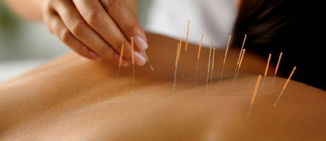 Acupuncture in North York