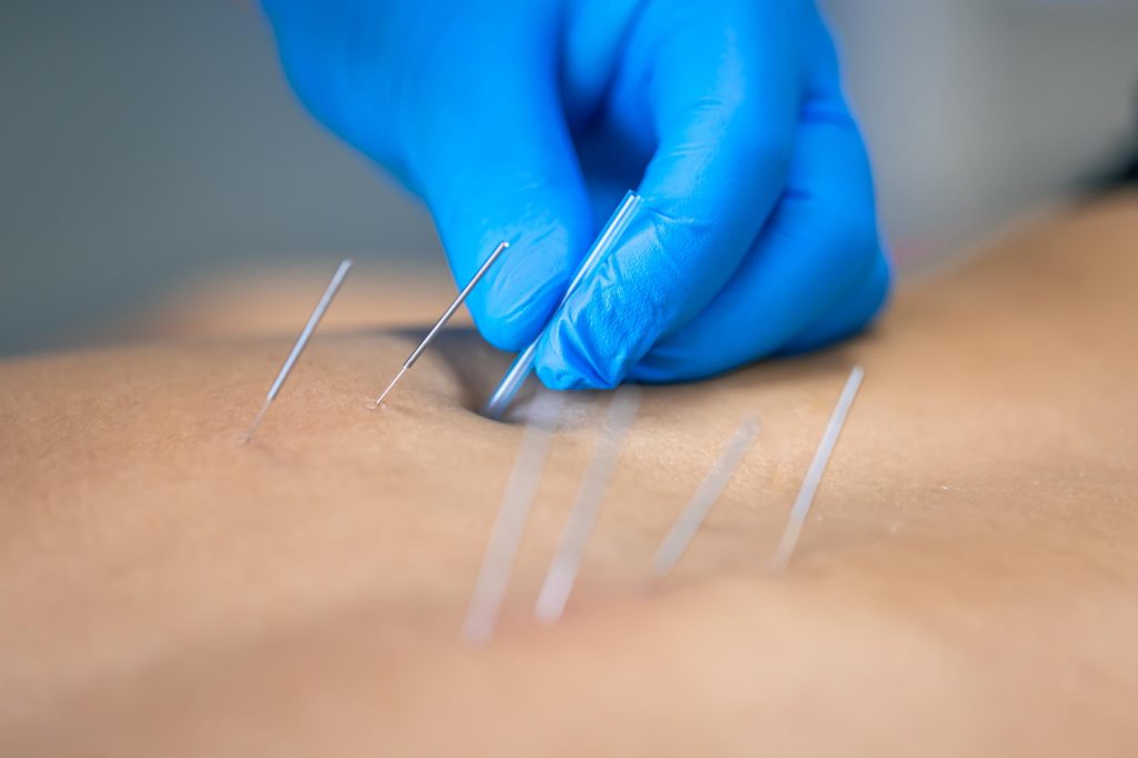 acupuncture in North York